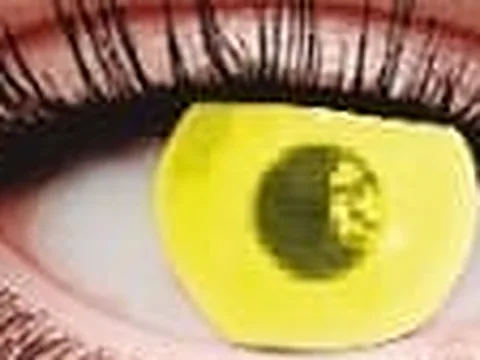 Lente de contacto de color Anyday ZY-912: neón amarillo, en un ojo