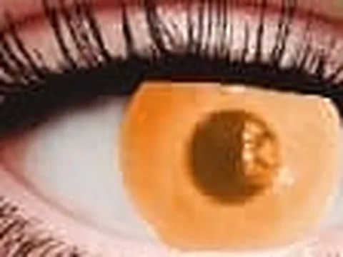 Lente de contacto de color Anyday ZY-913: neón naranja, en un ojo